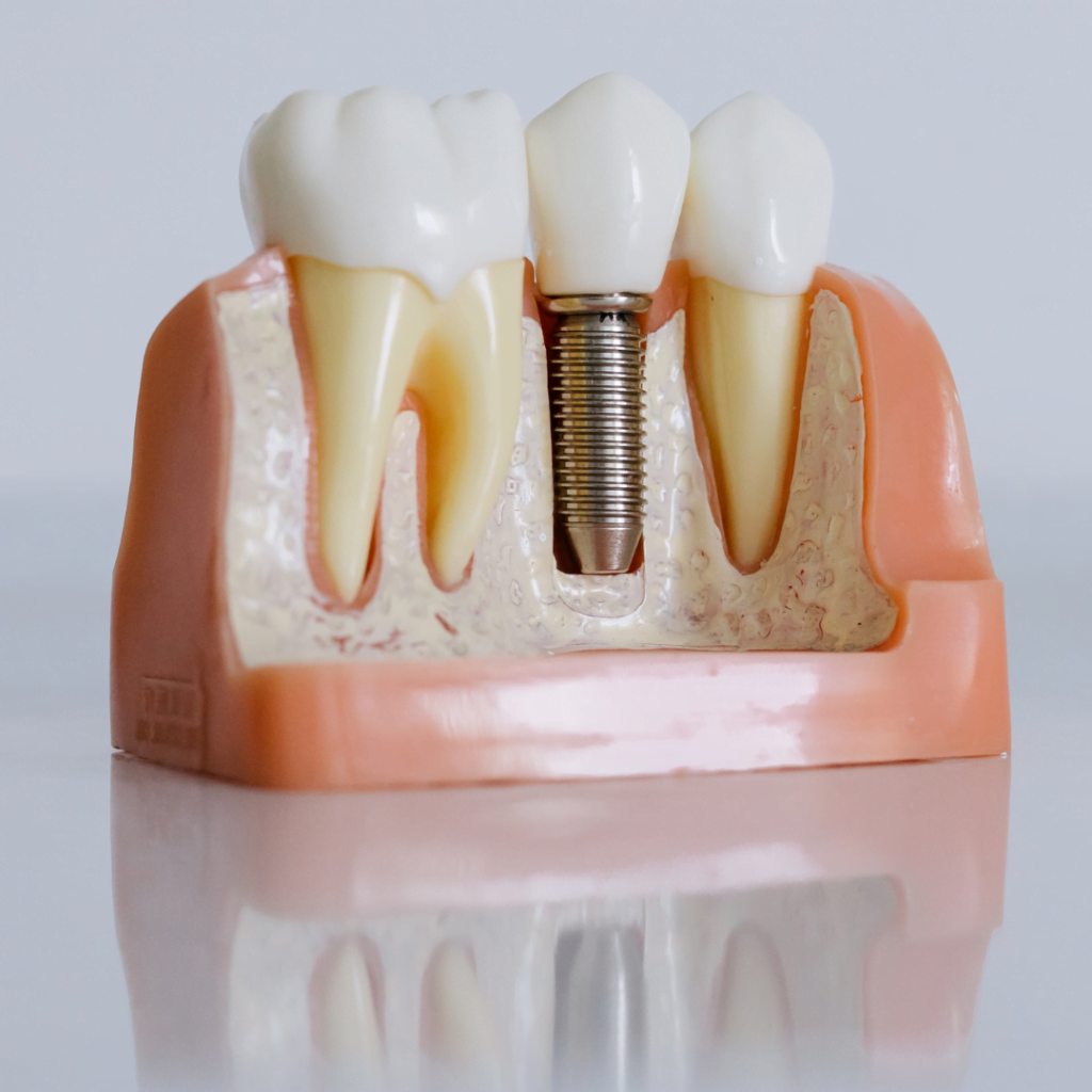 Best Dental Implants Treatment Near Me | Dental Clinic near KPHB Kukatpally