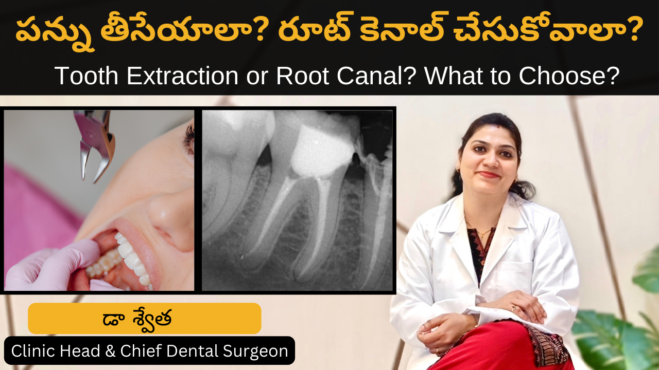 పన్ను తీసేయాలా లేదా రూట్ కెనాల్ చేసుకోవాలా? Tooth Extraction or Root Canal? in Telugu by Dr Swetha 4 పన్ను తీసేయాలా లేదా రూట్ కెనాల్ చేసుకోవాలా? Tooth Extraction or Root Canal? in Telugu by Dr Swetha