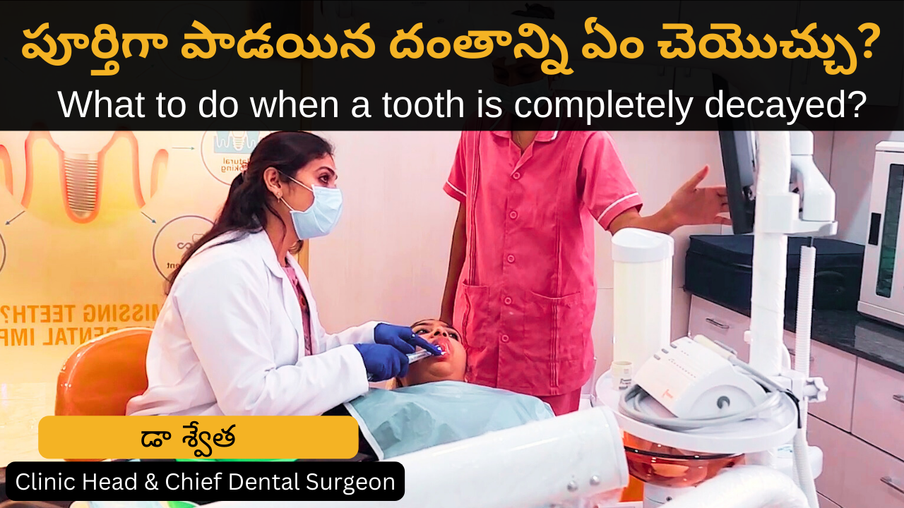 పూర్తిగా పాడయిన దంతాన్ని ఏం చెయొచ్చు? What to do when a tooth is completely decayed? in Telugu by Dr Swetha | Dentist in KPHB & Kukatpally 2 పూర్తిగా పాడయిన దంతాన్ని ఏం చెయొచ్చు? What to do when a tooth is completely decayed? in Telugu by Dr Swetha | Dentist in KPHB & Kukatpally
