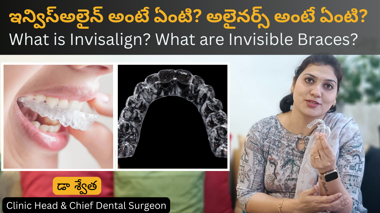 ఇన్విస్అలైన్ అంటే ఏంటి? What is Invisalign or Invisible Braces? in Telugu by Dr Swetha 2 ఇన్విస్అలైన్ అంటే ఏంటి? What is Invisalign or Invisible Braces? in Telugu by Dr Swetha