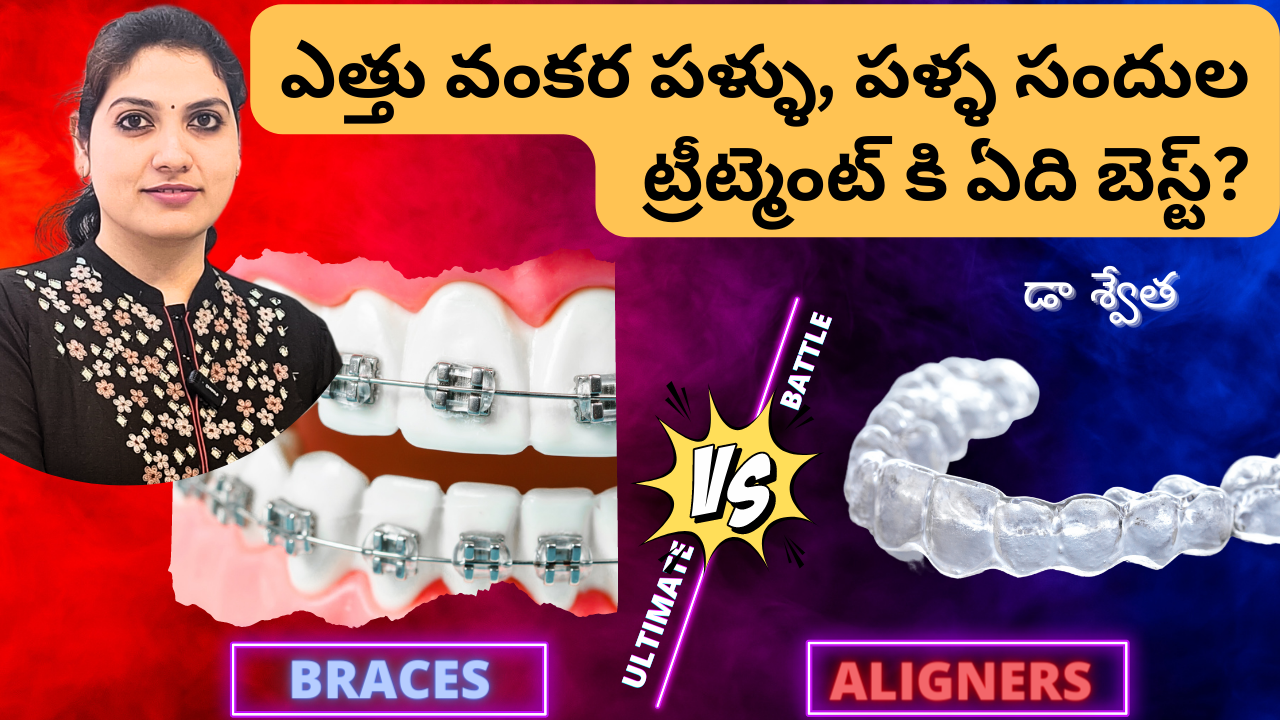 Braces Vs Aligners Which Is The Best Option For Teeth Straightening