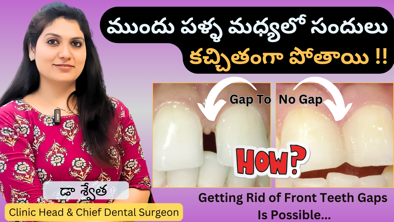 Teeth Gap Treatment | Diastema | Gap Teeth Filling | Front Teeth Gap in Telugu | Dr Swetha | Dentist @ KPHB, Manikonda & Kondapur